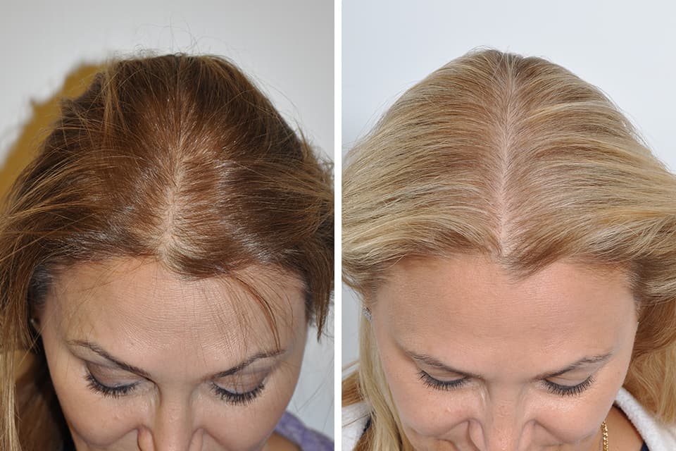 Türkei haartransplantation: Erwartungen vs. Realität