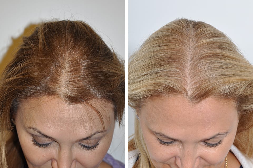 Türkei haartransplantation: Erwartungen vs. Realität